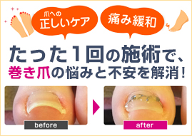 痛くない、怖くない、巻き爪矯正が可能です
